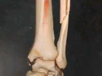 开云体育app-穆西亚拉腓骨骨折+韧带受伤预计伤缺4-5个月的简单介绍