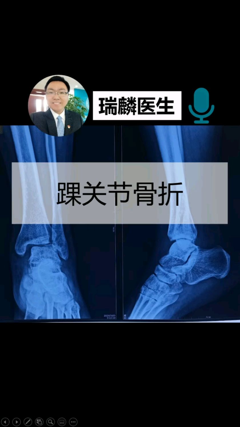 穆西亚拉腓骨骨折+韧带受伤预计伤缺4-5个月的简单介绍